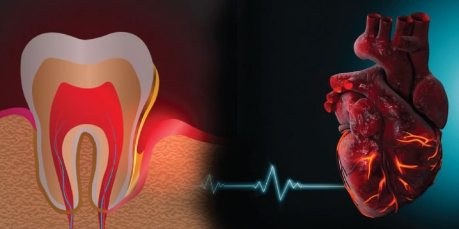Dhëmbët e këqij shkaktojnë probleme me zemrën, simptomat dhe shenjat paralajmëruese