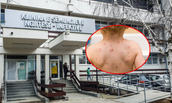IKSHPK: Për një muaj janë konfirmuar 14 raste të fruthit, vaksinoni fëmijët – rreziku për komplikime është serioz